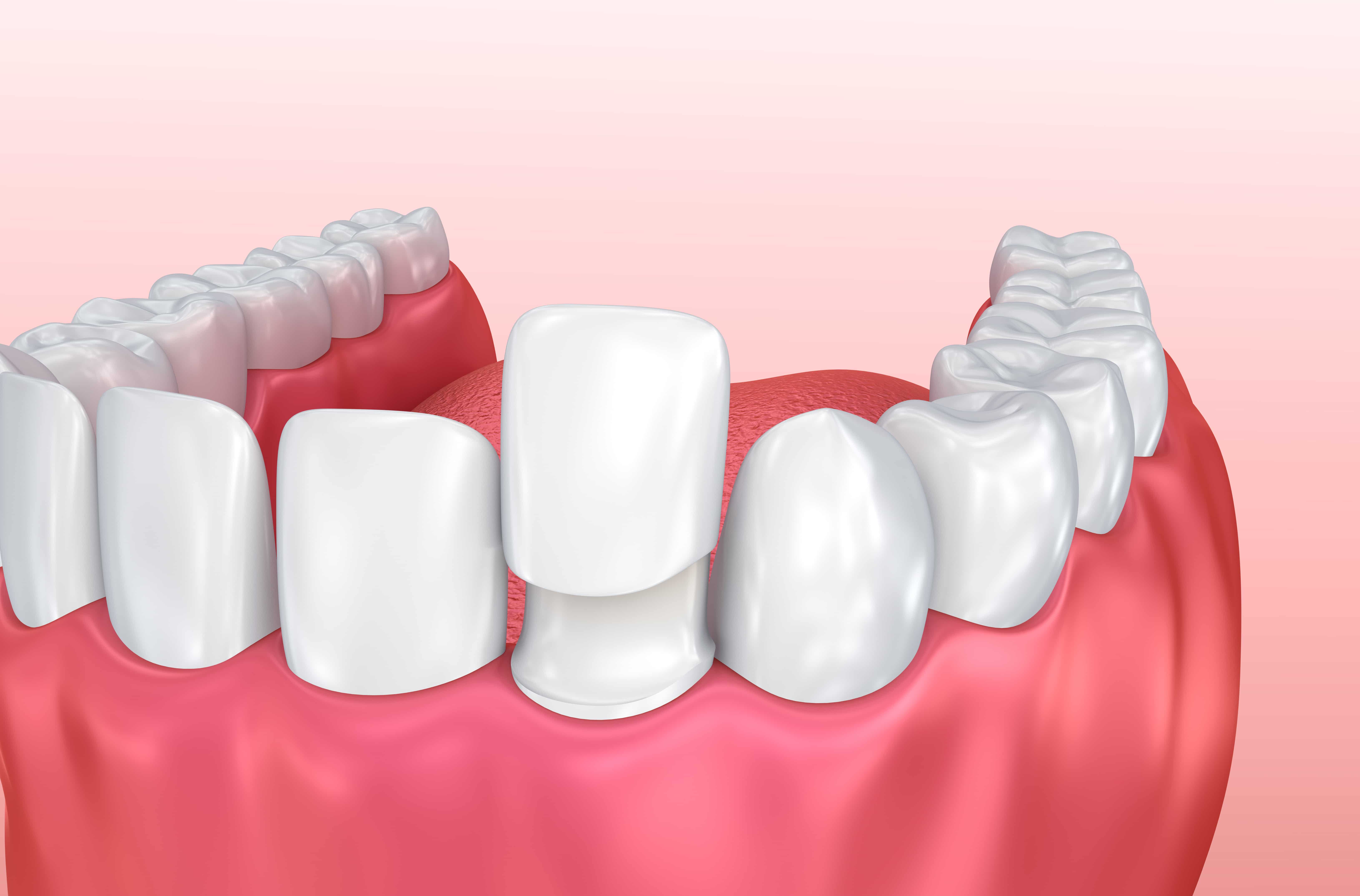 Houston Dentist Discusses Instant Smile Improvement With Porcelain Veneers Houston, TX