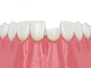 chipped tooth that needs emergency dentistry