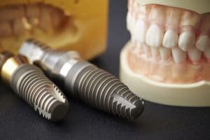 placing dental implants