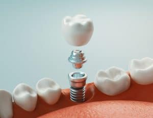 placing dental implants