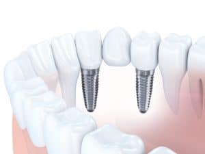 securing dental bridges with dental implants
