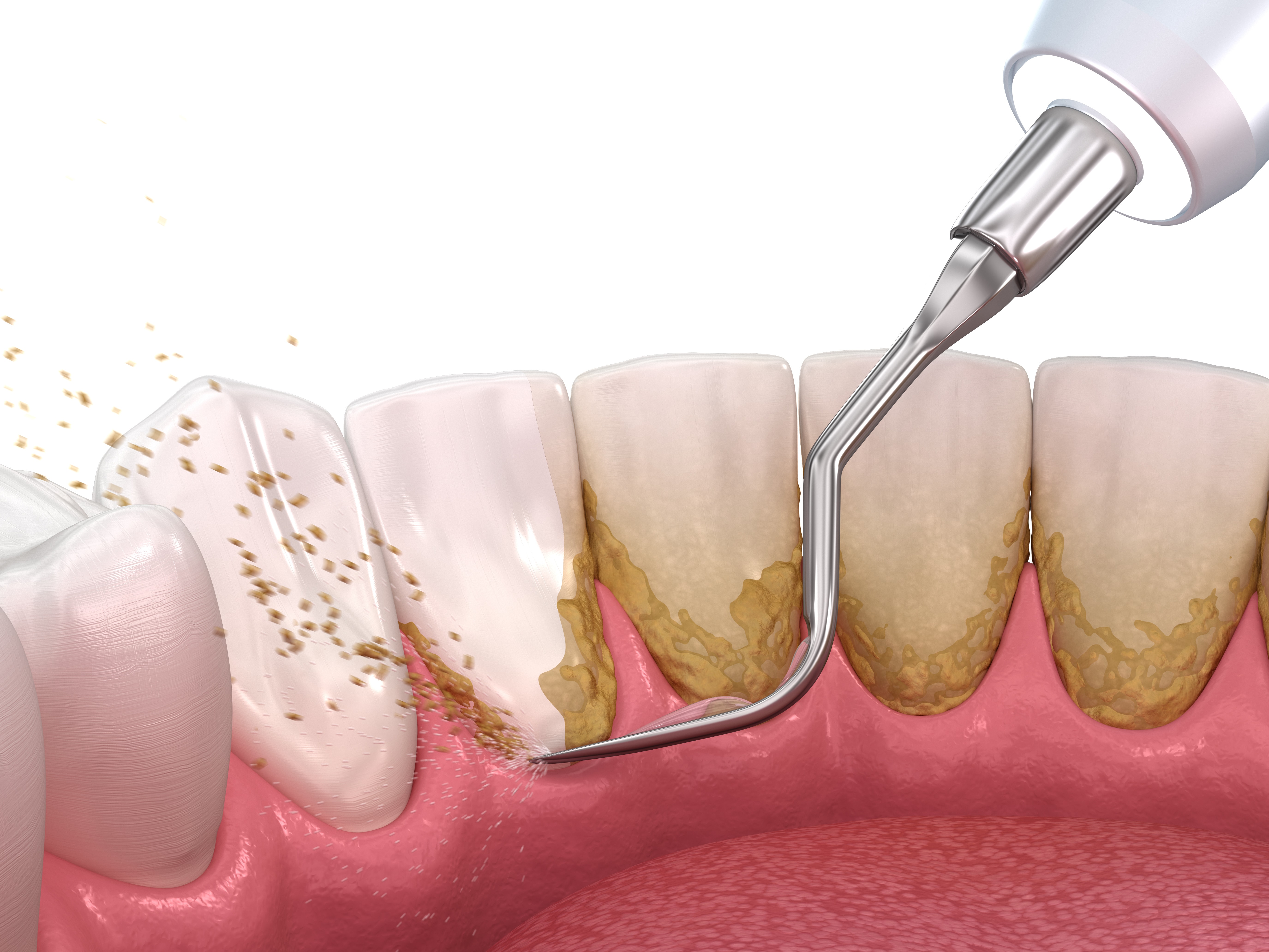 Seeking Periodontal Treatment In Houston Houston TX Houston TX