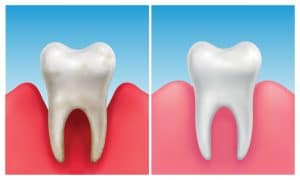 The Long-Term Impact of Gum Disease