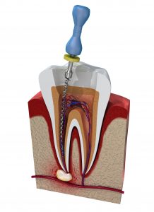 houston root canal infection