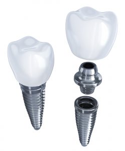 houston dental implants