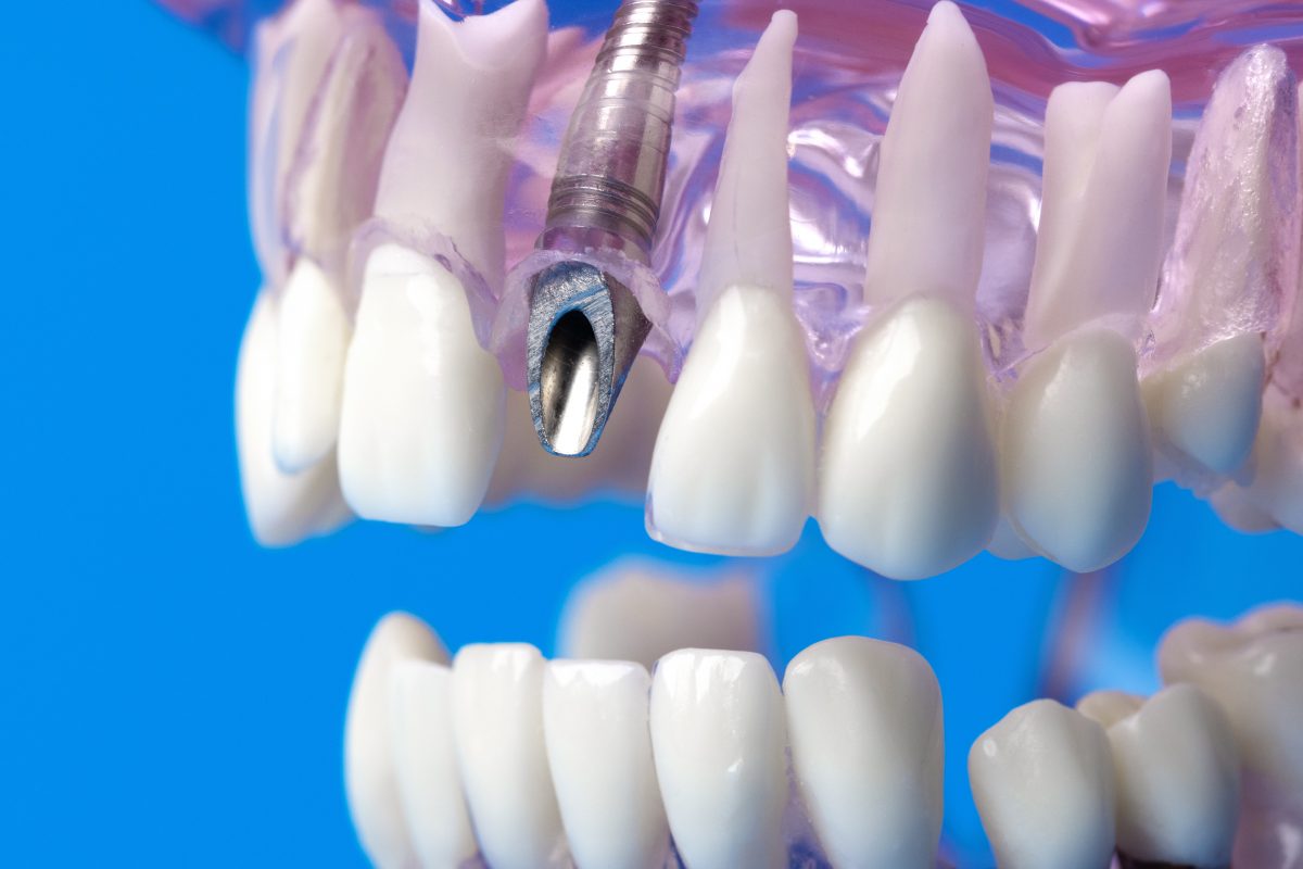 How Do We Implant A New Tooth? | Houston, TX | Houston, TX