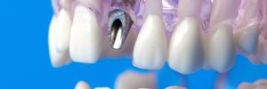 houston dental implant placement