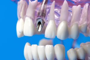 houston dental implant placement