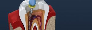 houston root canal