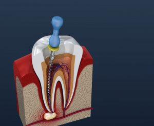 houston root canal