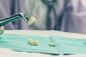 houston tooth extraction