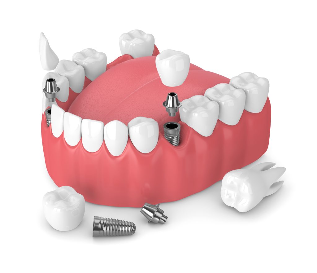 Placing A Dental Implant Houston, TX Houston, TX