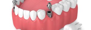 houston dental implants