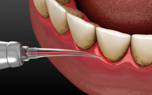 houston gum contouring