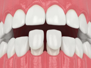 houston veneers