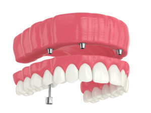houston complete dentures
