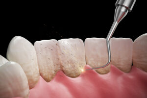 houston periodontal treatment