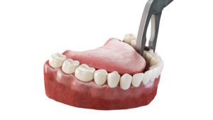 houston dental extraction