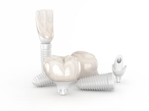 houston dental implants