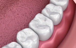 Fissure dental fillings, Medically accurate 3D illustration