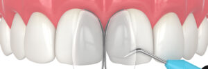 houston dental bonding