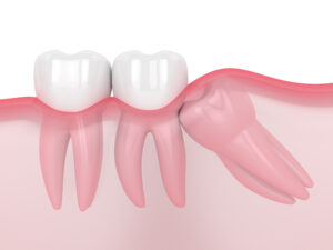 Houston, TX, dentist offers wisdom tooth removals and oral surgery 